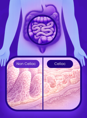 Diagram of the digestive system comparing healthy small intestine villi with those damaged by celiac disease